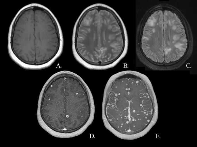 MRI of neurocysticercosis with multiple lesions