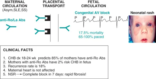 Neonatal Lupus: Pathophysiology, ECG, Rash, Clinical Facts