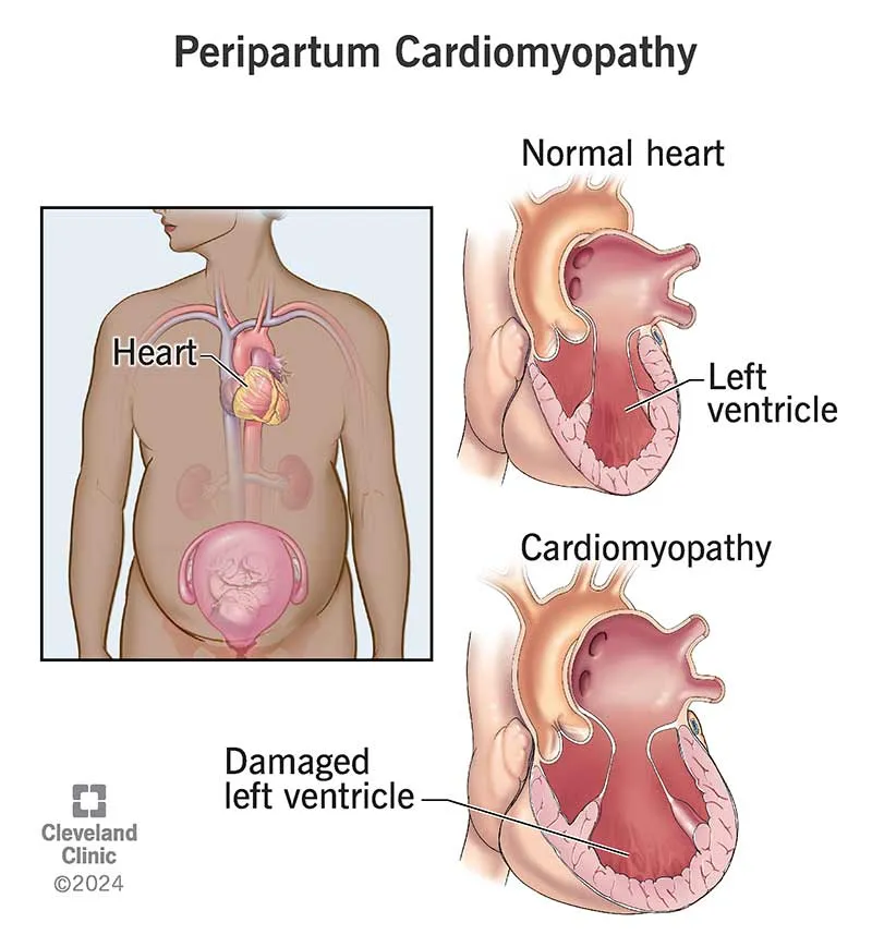 Peripartum Cardiomyopathy: Normal vs. Damaged Heart