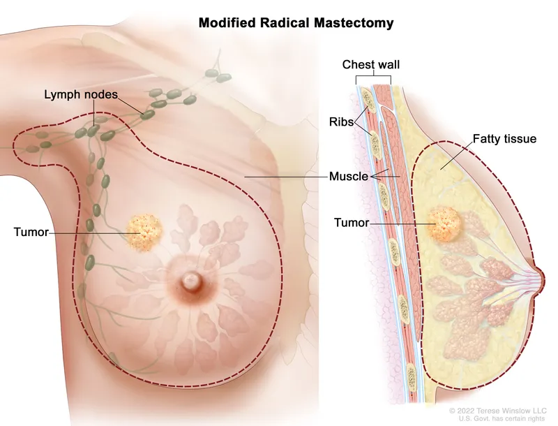 Modified Radical Mastectomy for Breast Cancer