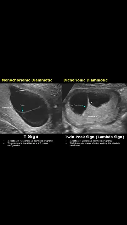 Twin Peak vs. T Sign in Multiple Gestation Ultrasound
