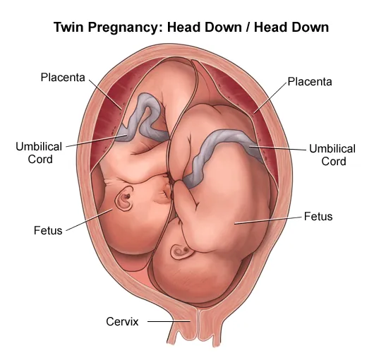 Twin Pregnancy: Both Fetuses Head Down