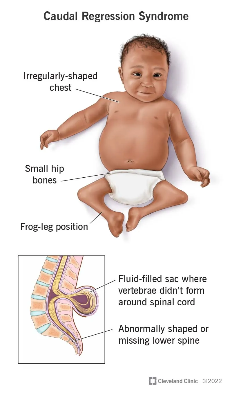 Caudal Regression Syndrome in Infants