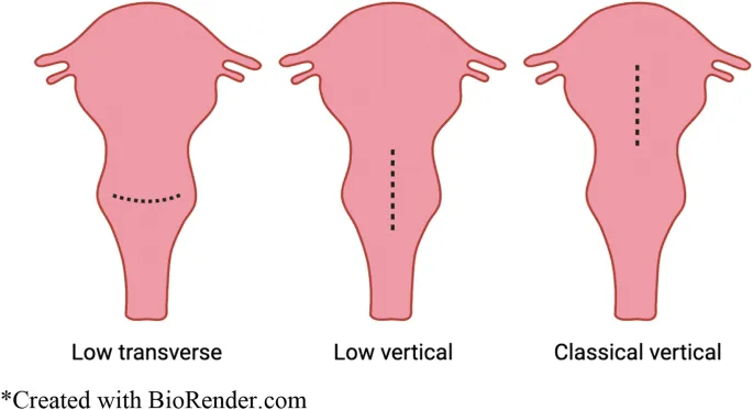 Uterine Incisions: Low Transverse, Low Vertical, Classical