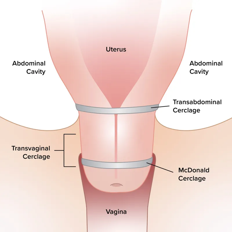 Transabdominal and Transvaginal Cerclage Procedures