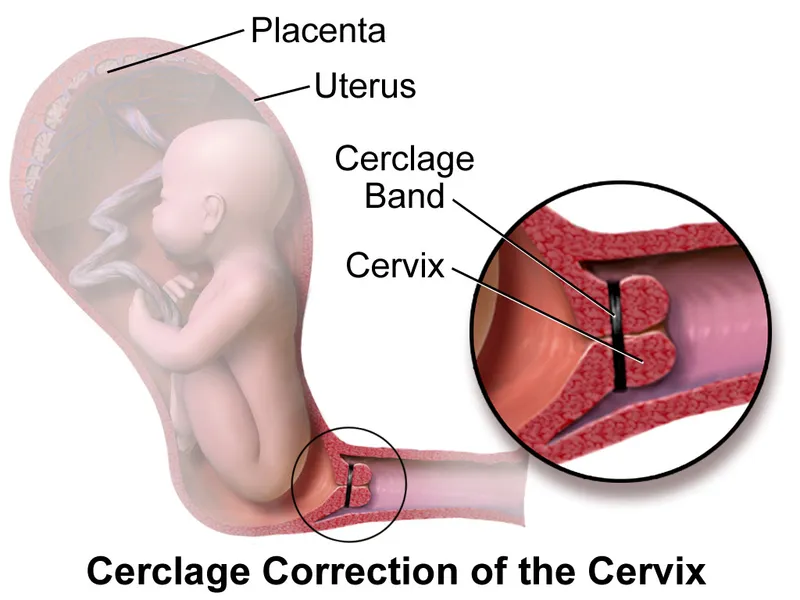 Cervical Cerclage Illustration