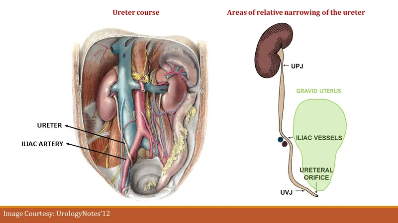 Ureter course and narrowing in pregnancy