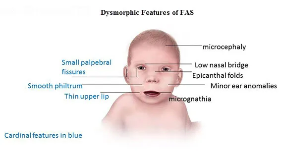 Fetal Alcohol Syndrome (FAS) Dysmorphic Facial Features