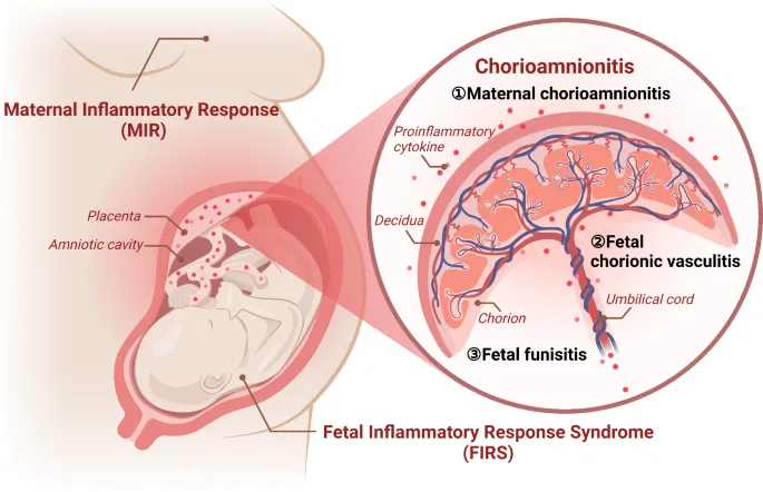 Chorioamnionitis: Maternal and Fetal Inflammatory Response