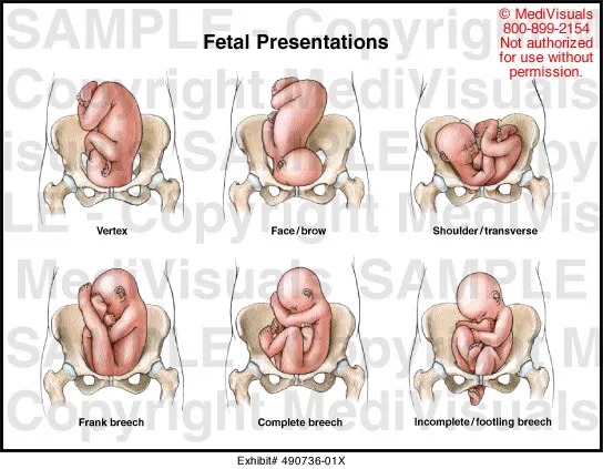 Fetal Malpresentations: Breech, Face, Brow