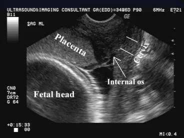 Transvaginal ultrasound: complete placenta previa