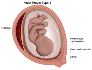 Vasa Previa Type 1: Fetal vessels near cervix