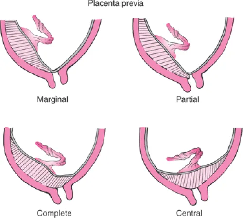 Placenta previa: marginal, partial, complete, and central