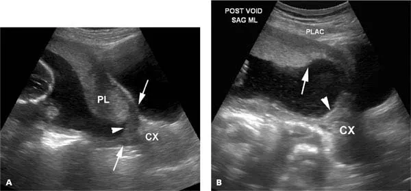 Sagittal ultrasound of placenta previa