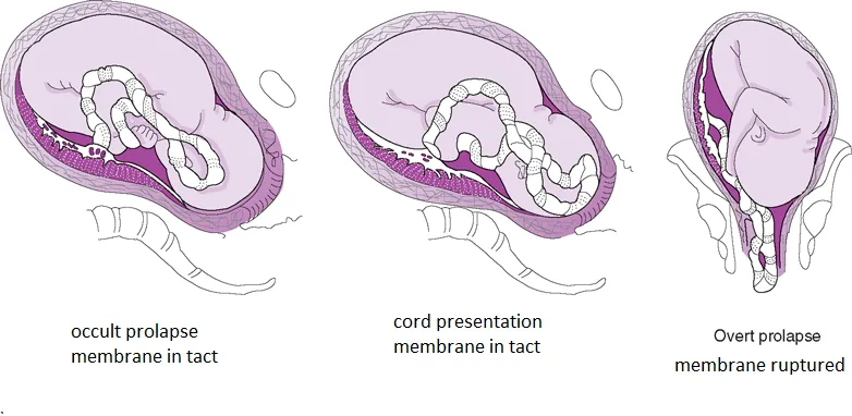 Umbilical cord prolapse types