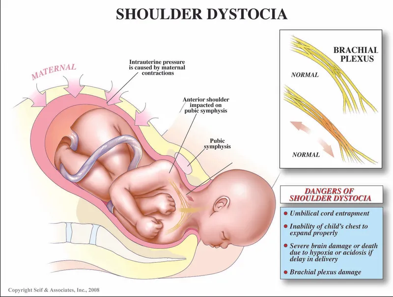 Shoulder Dystocia: Impaction and Potential Complications