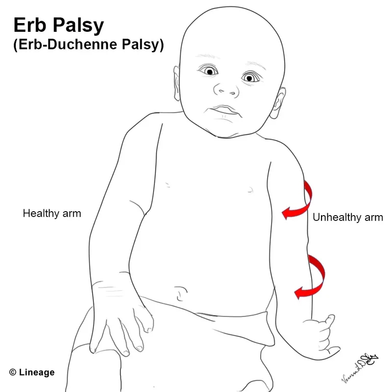 Erb’s Palsy (Waiter’s Tip Posture) in a Newborn