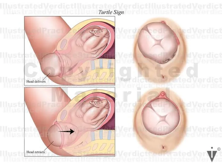 Turtle Sign in Shoulder Dystocia