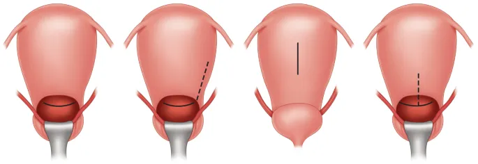 Uterine incisions: low-transverse vs. classical