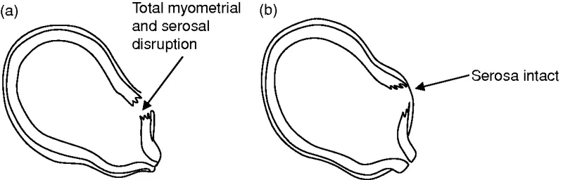 Complete uterine rupture vs. incomplete dehiscence