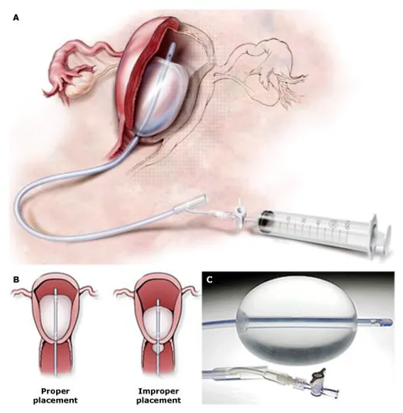 Bakri balloon tamponade: placement and inflation