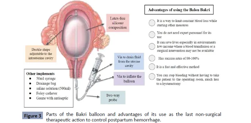 Bakri Balloon: Parts, Implements, and Advantages