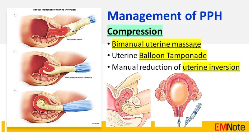 PPH Management: Compression Techniques