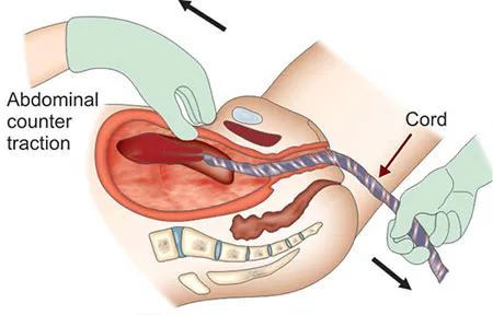 Controlled cord traction with uterine counter-traction