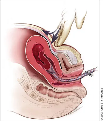Brandt-Andrews maneuver for retained placenta