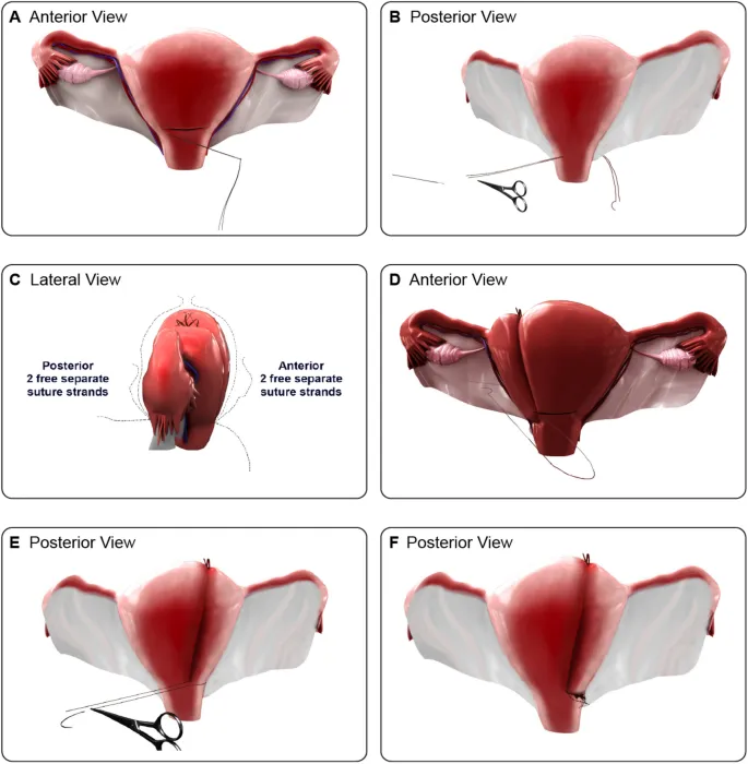 B-Lynch Suture Placement for Postpartum Hemorrhage