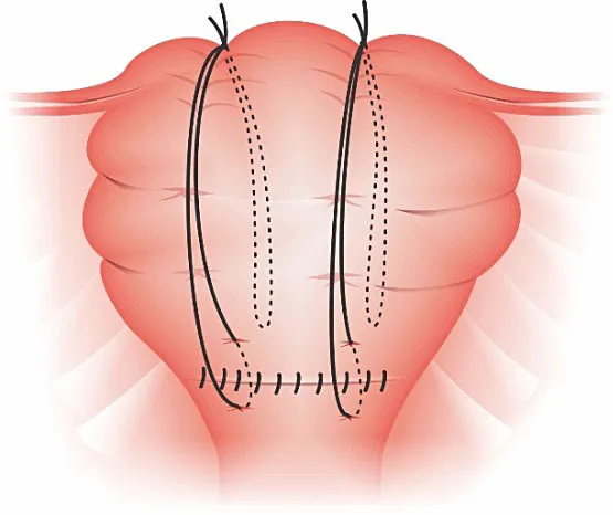 Uterine Compression Sutures Illustration