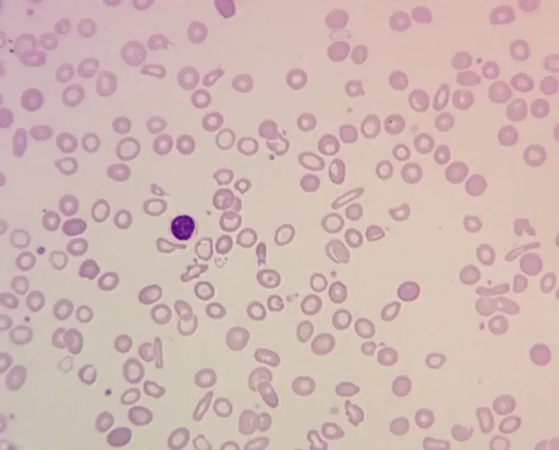 Peripheral blood smear: microcytic, hypochromic RBCs
