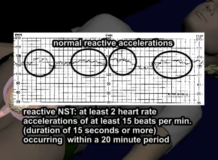 Reactive NST Tracing with Normal Accelerations