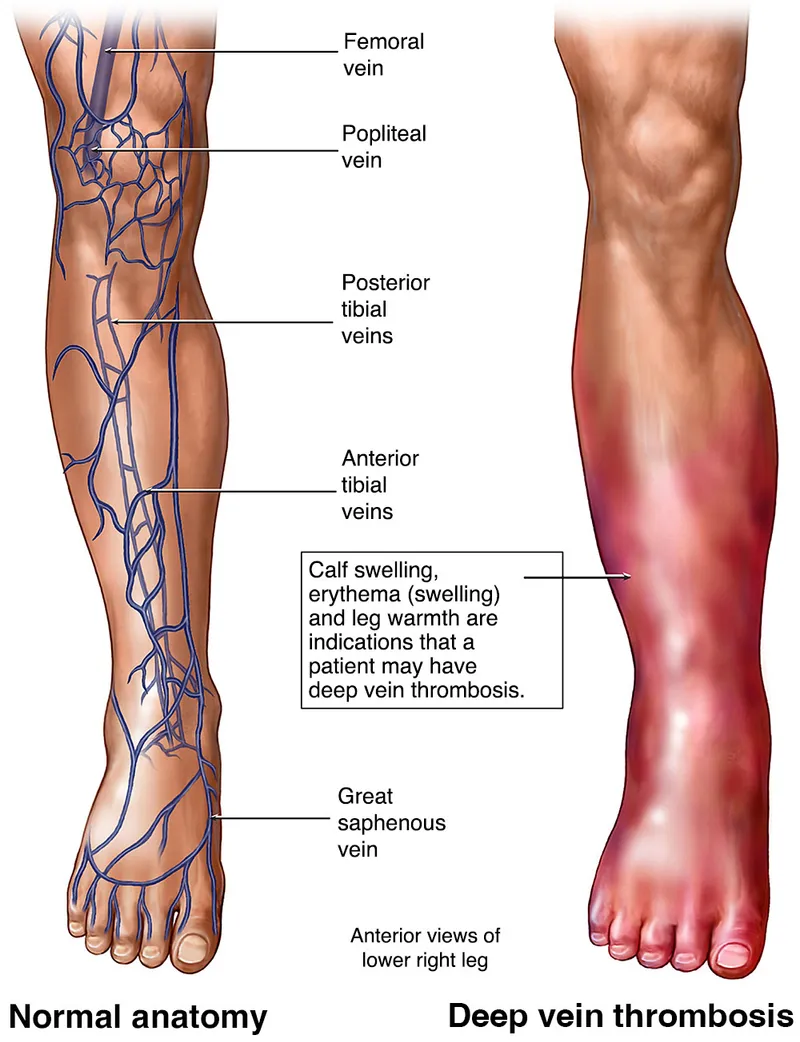 Deep Vein Thrombosis (DVT) vs. Normal Leg Anatomy