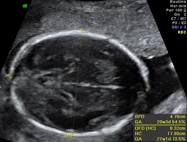 Fetal Head Ultrasound with BPD and HC Measurements