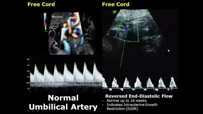 Umbilical Artery Doppler: Normal vs. Reversed Flow