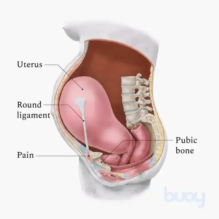 Round Ligament Pain in Pregnancy