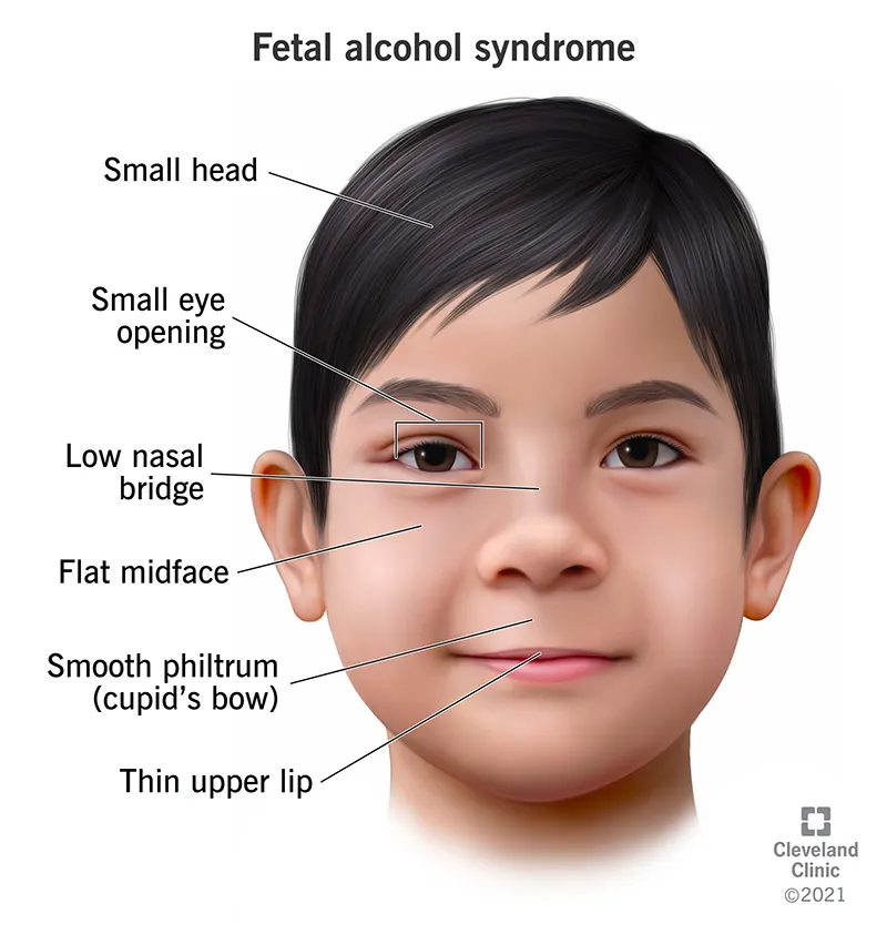 Fetal Alcohol Syndrome: Key Facial Features