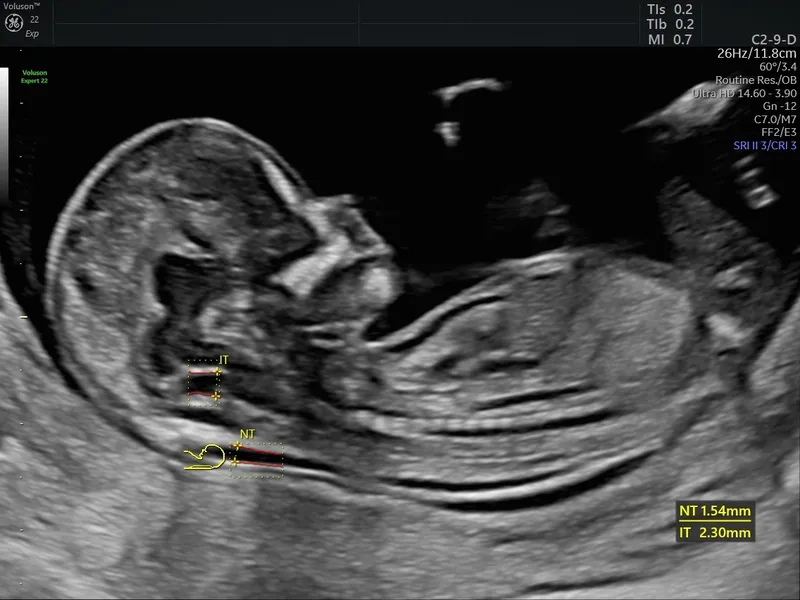 Fetal Nuchal Translucency Ultrasound