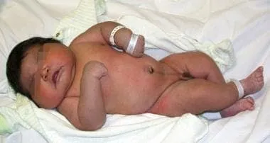 Infant with macrosomia due to gestational diabetes