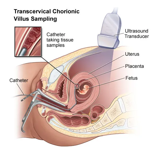Transvaginal Chorionic Villus Sampling (CVS)