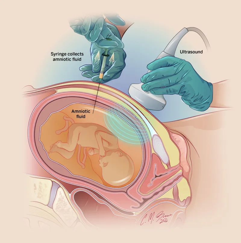 Ultrasound-guided amniocentesis procedure