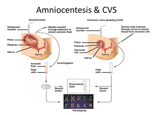 Amniocentesis vs. CVS procedure and karyotyping