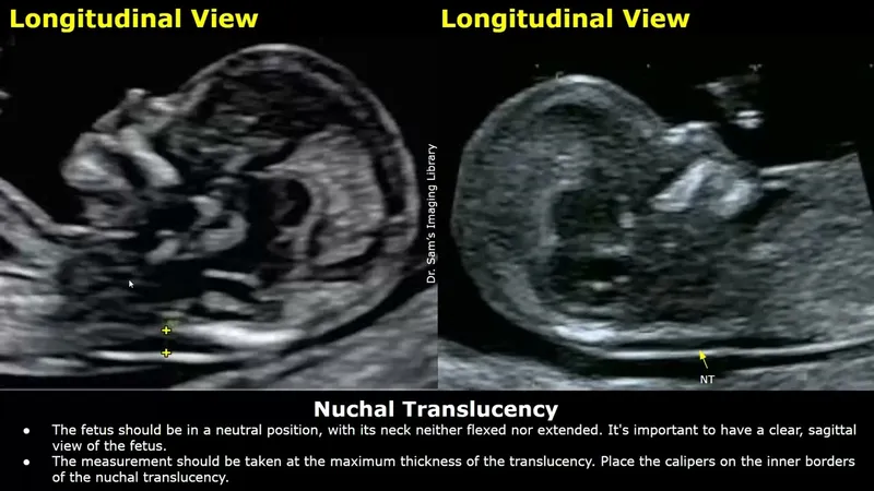 Fetal Nuchal Translucency Ultrasound Measurement