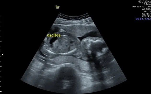 Ultrasound: Fetal ascites in hydrops fetalis