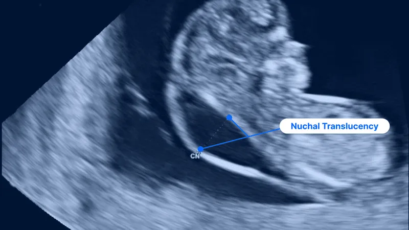 Fetal ultrasound showing nuchal translucency measurement