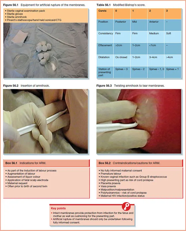Artificial Rupture of Membranes (ARM) Procedure
