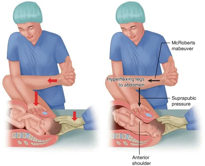 McRoberts maneuver for shoulder dystocia