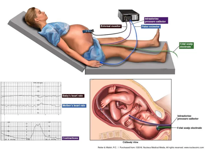 Fetal Monitoring: External and Internal Methods