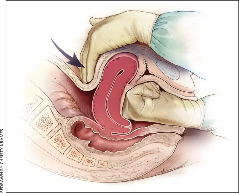 Bimanual uterine compression for uterine atony